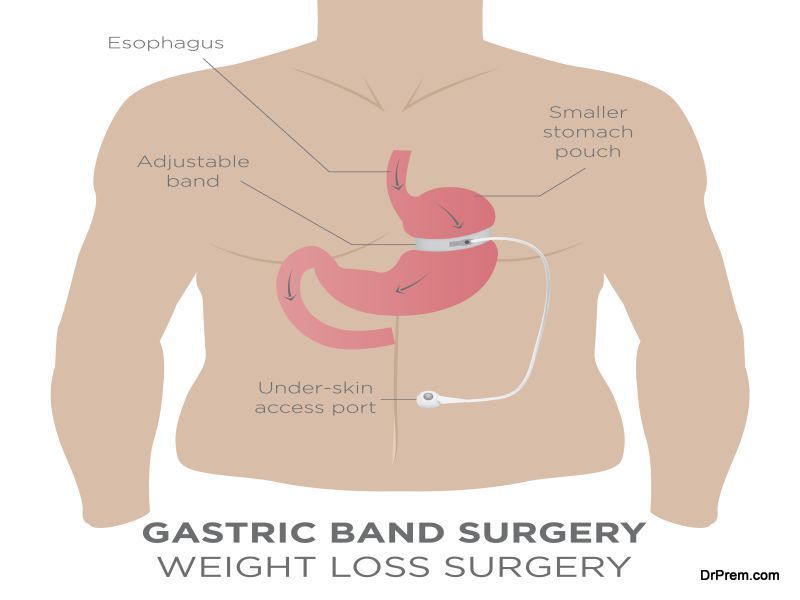 bariatric surgery